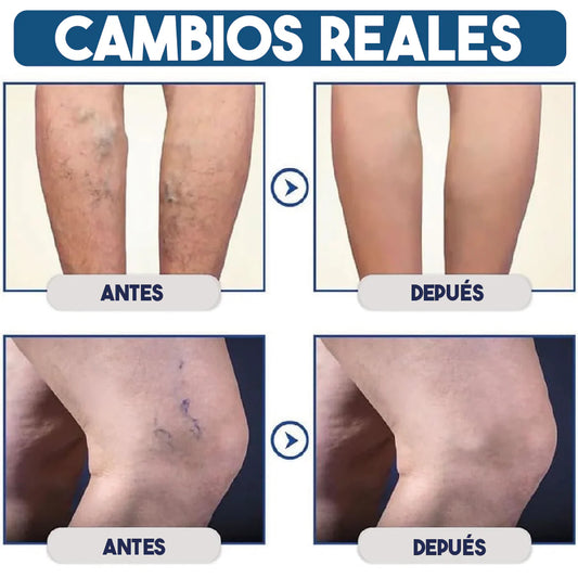 Combo Medias de Compresión + Gel Antivárices VEINS | Alivio Inmediato para Piernas Hinchadas y con Dolor