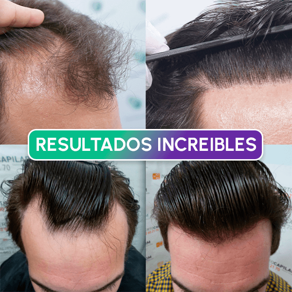 Cabello instantáneo + Envío GRATIS