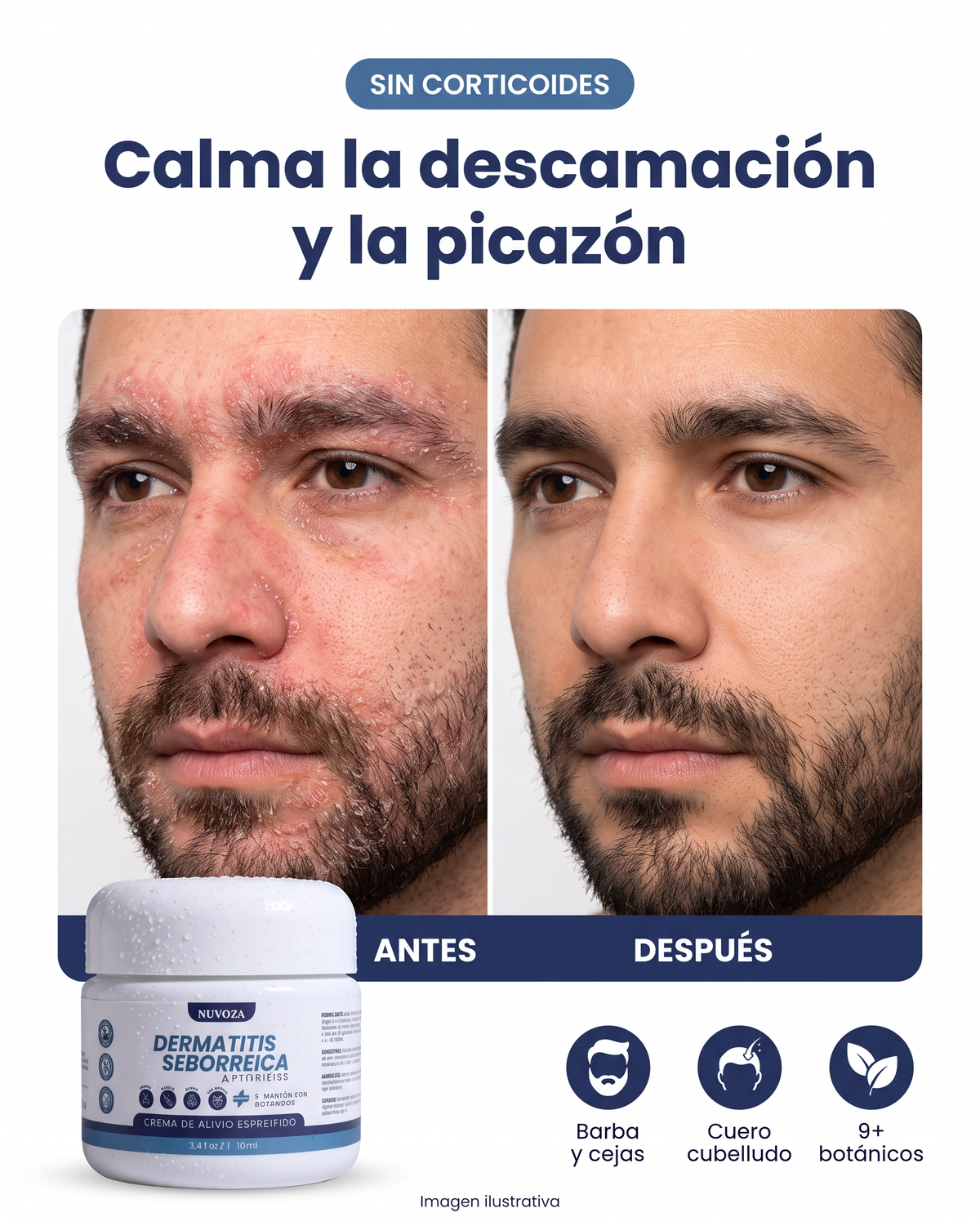 Nuvora, crema para dermatitis seborreica