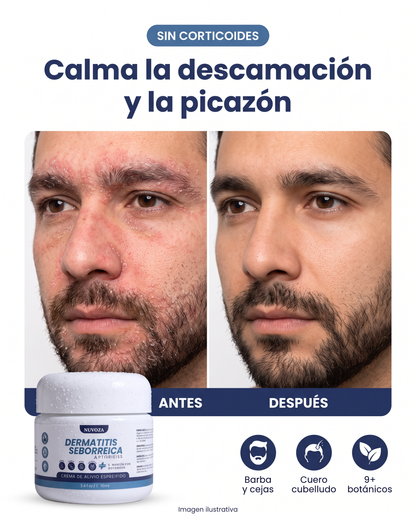 Nuvora, crema para dermatitis seborreica